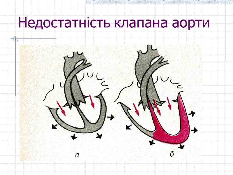 Недостатність клапана аорти